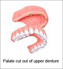 palate cut out of upper denture