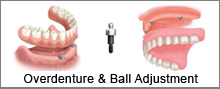 overdenture and ball adjustment