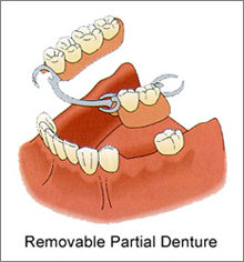 removable partial denture